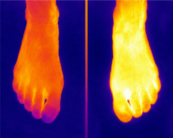 Feet recovering sensation after OCB treatment
